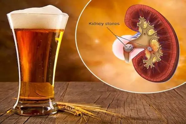 Beer for kidney stones and gallbladder