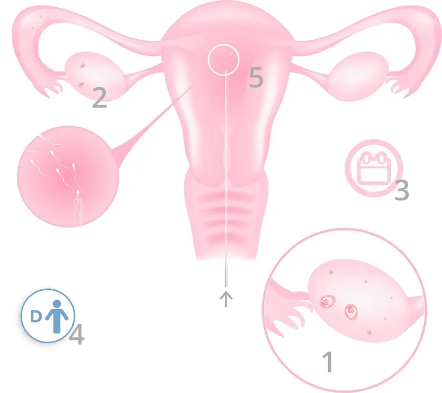 IVF or artificial insemination with donor (IAD): the different stages