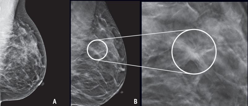 Mammography: why is it so difficult to decide on it?