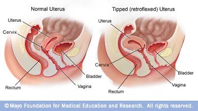 Retroverted uterus, pregnancy and childbirth: what you need to know