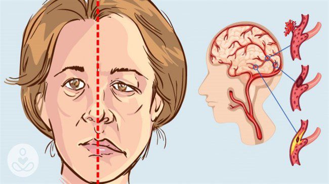 Stroke: how to recognize it in person?