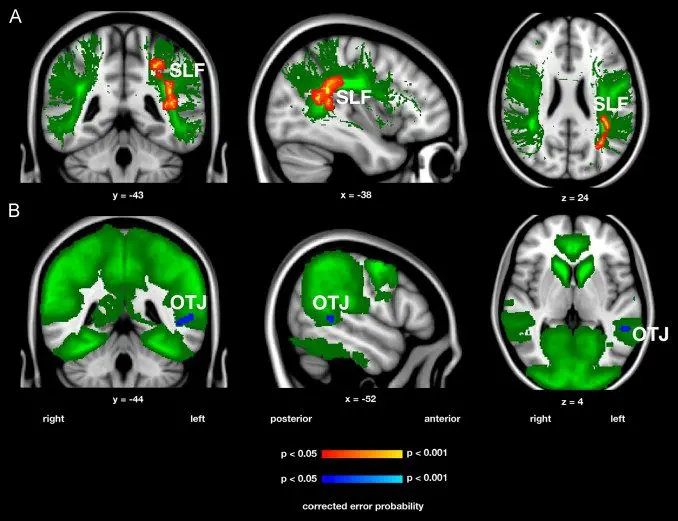 The brain of a chess player: what are its advantages?