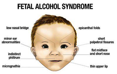 The dangers of drinking alcohol in early pregnancy