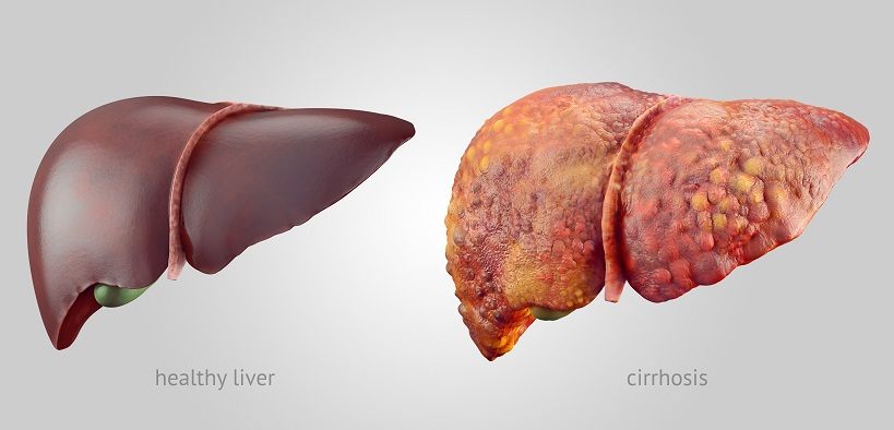 The effect of alcohol on the liver