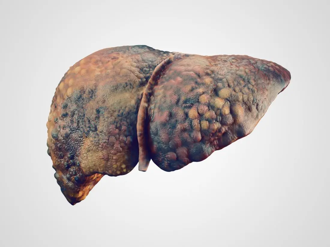 The effect of alcohol on the liver