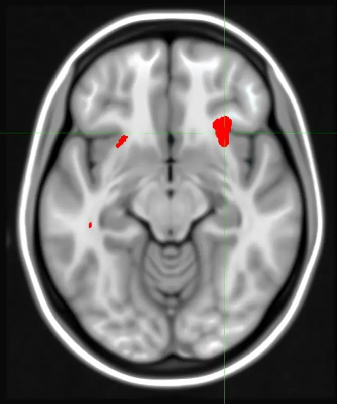 Tomogram predicts effectiveness of psychotherapy