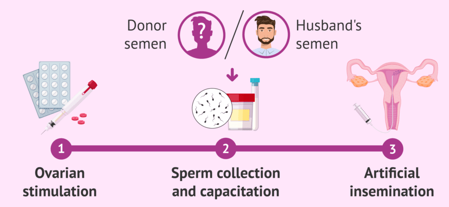 Update sa artificial insemination uban sa donor