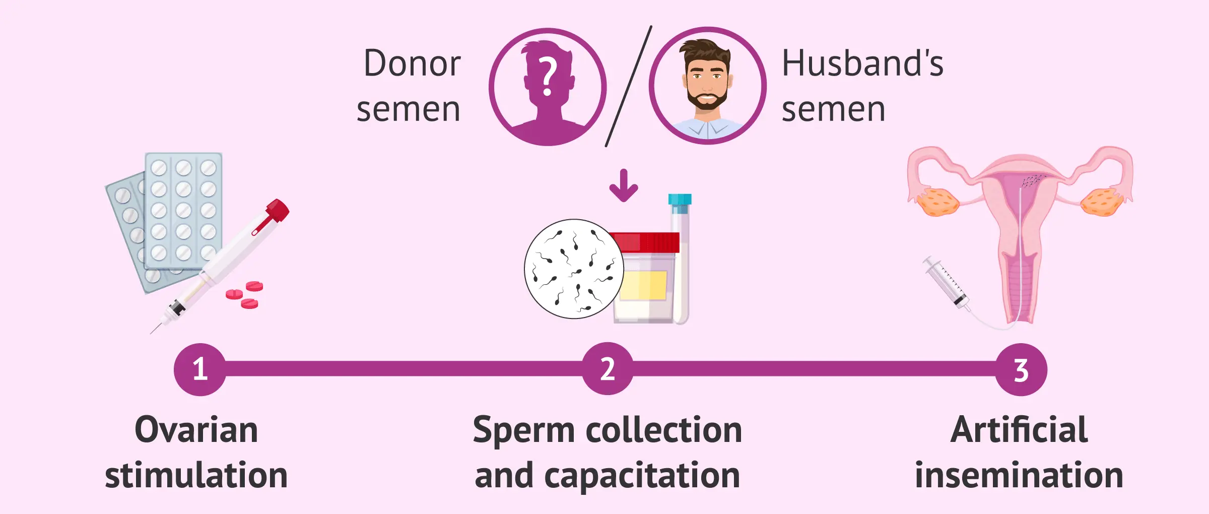 Update on artificial insemination with donor