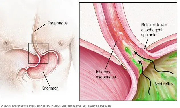 What to do if heartburn occurs after drinking alcohol