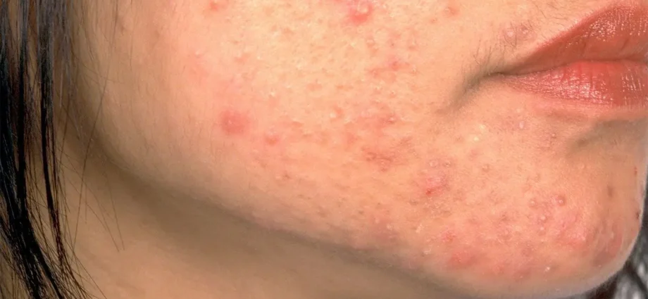 Acne, allergies, psoriasis: what does the skin tell us?