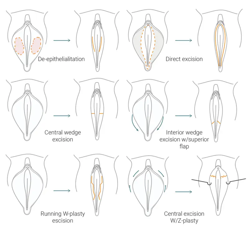 «Forbidden» topic: intimate plastic surgery, injections and cosmetics