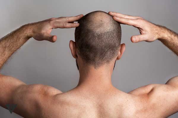 How to get rid of Peladophobia — fear of baldness?