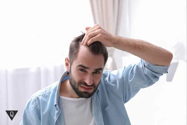 How to get rid of Peladophobia — fear of baldness?