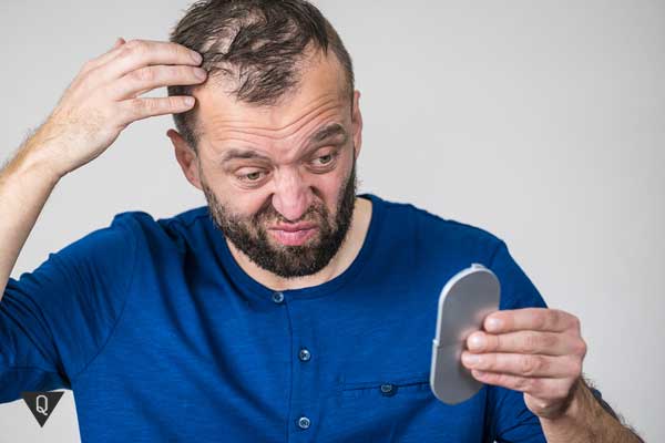 How to get rid of Peladophobia — fear of baldness?