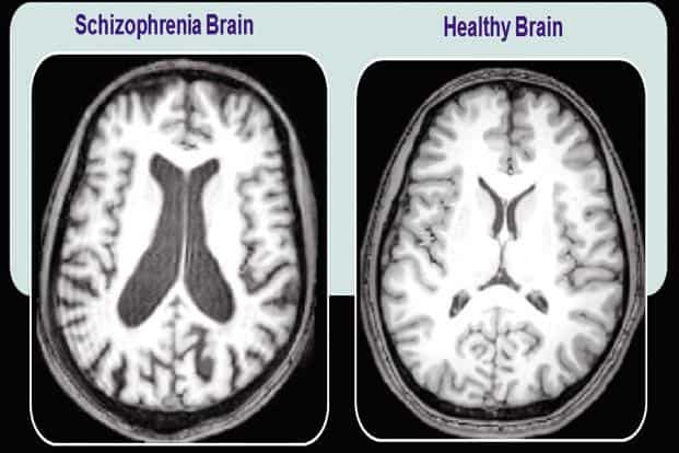 Schizophrenia – a disease of less and less mystery