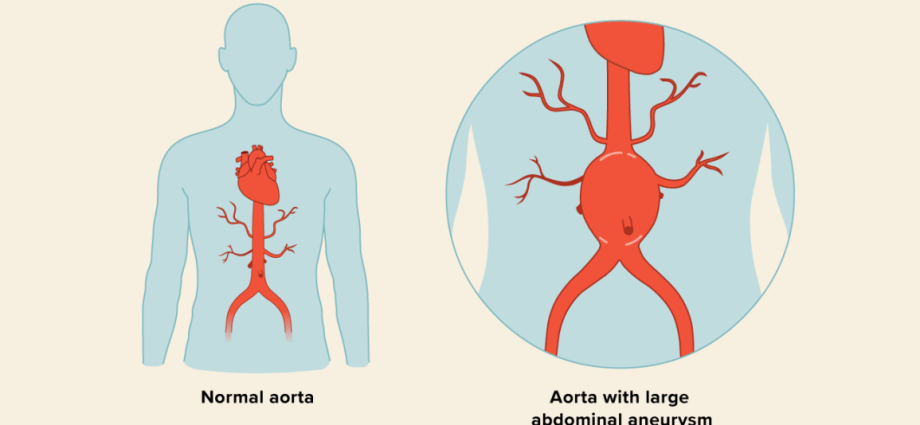 Abdominal aortic aneurysm in adults