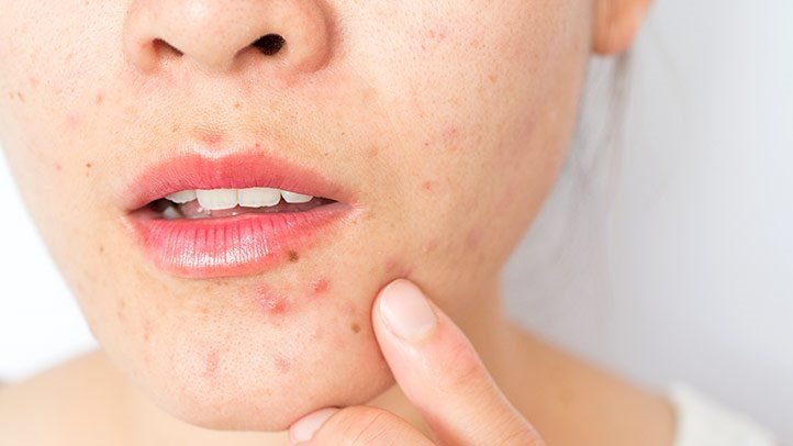 Acne in adults