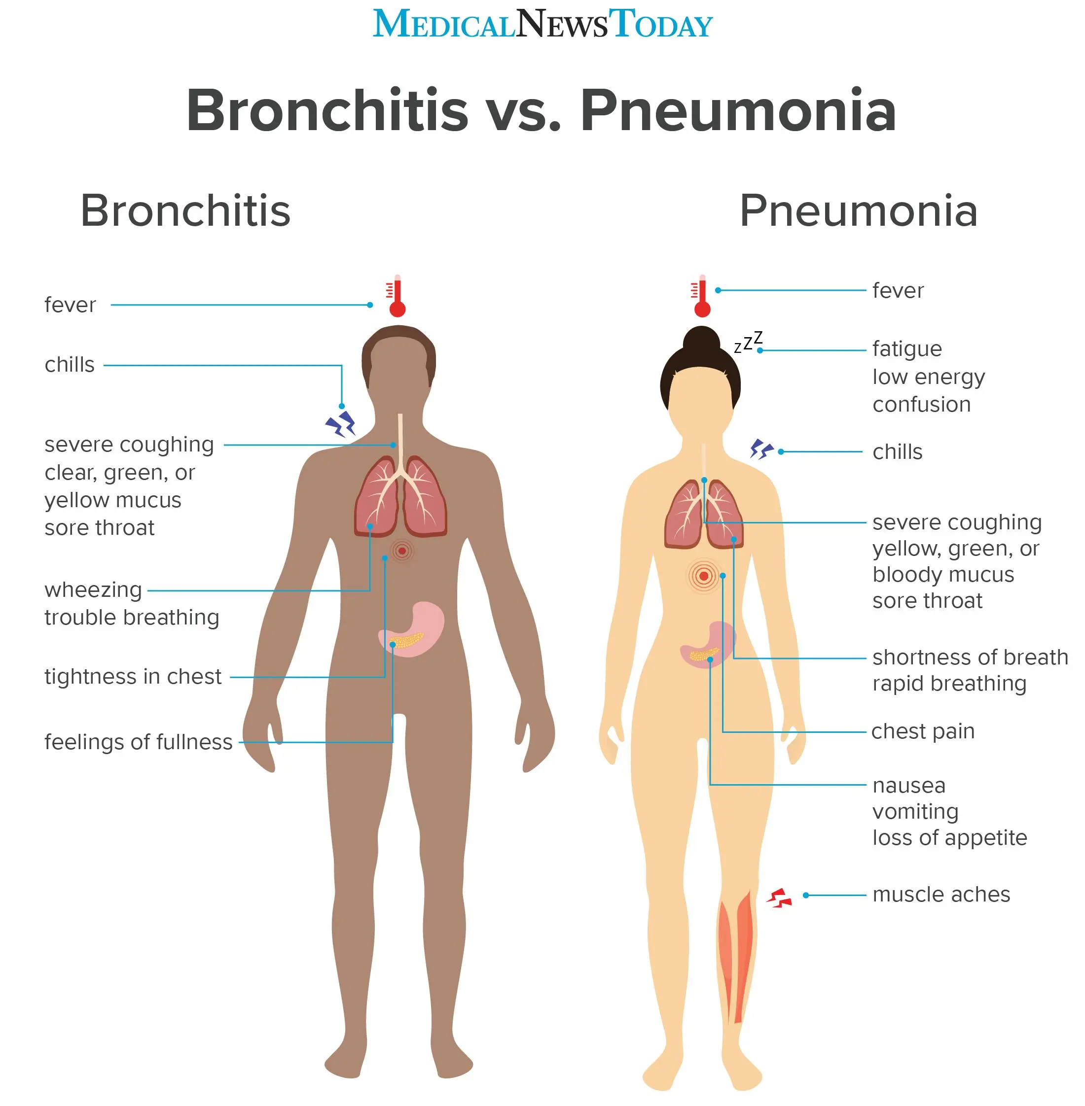 Acute pneumonia in adults