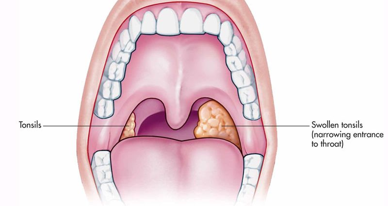 Acute tonsillitis in adults