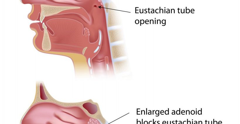 Adenoiditis in children