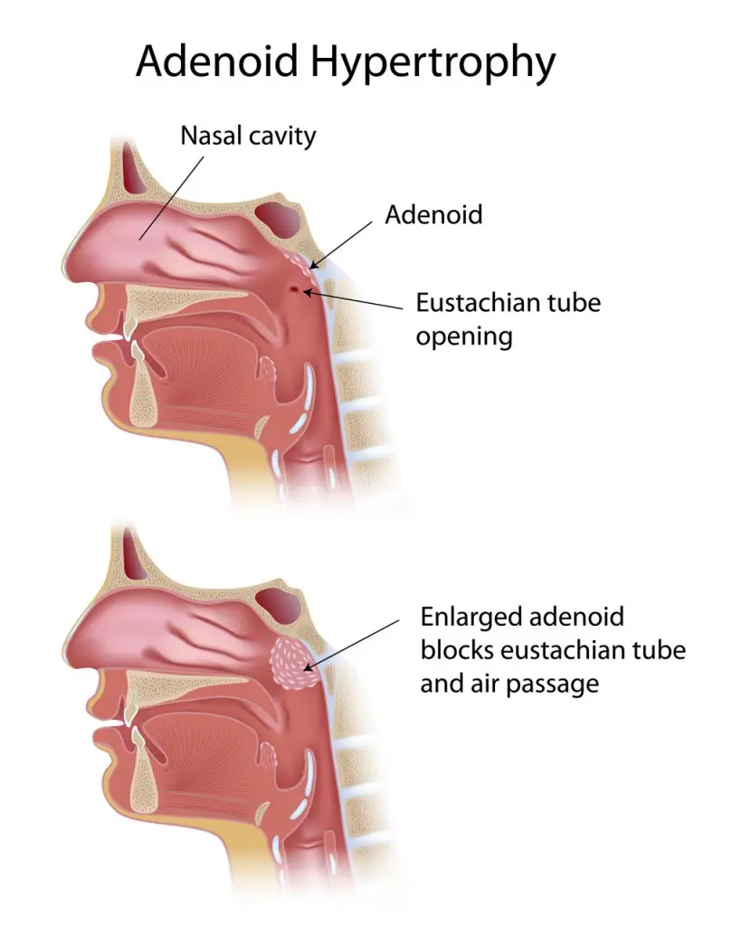 Adenoiditis in children