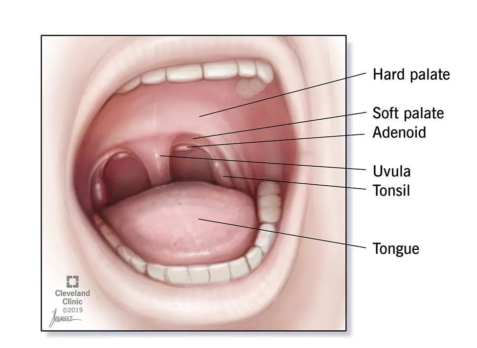 Adenoids in children