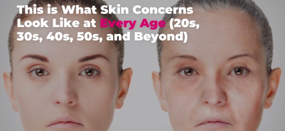 महिलाओं में उम्र से संबंधित त्वचा में बदलाव
