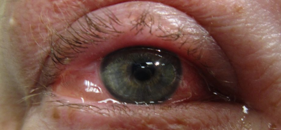 Allergic conjunctivitis in adults