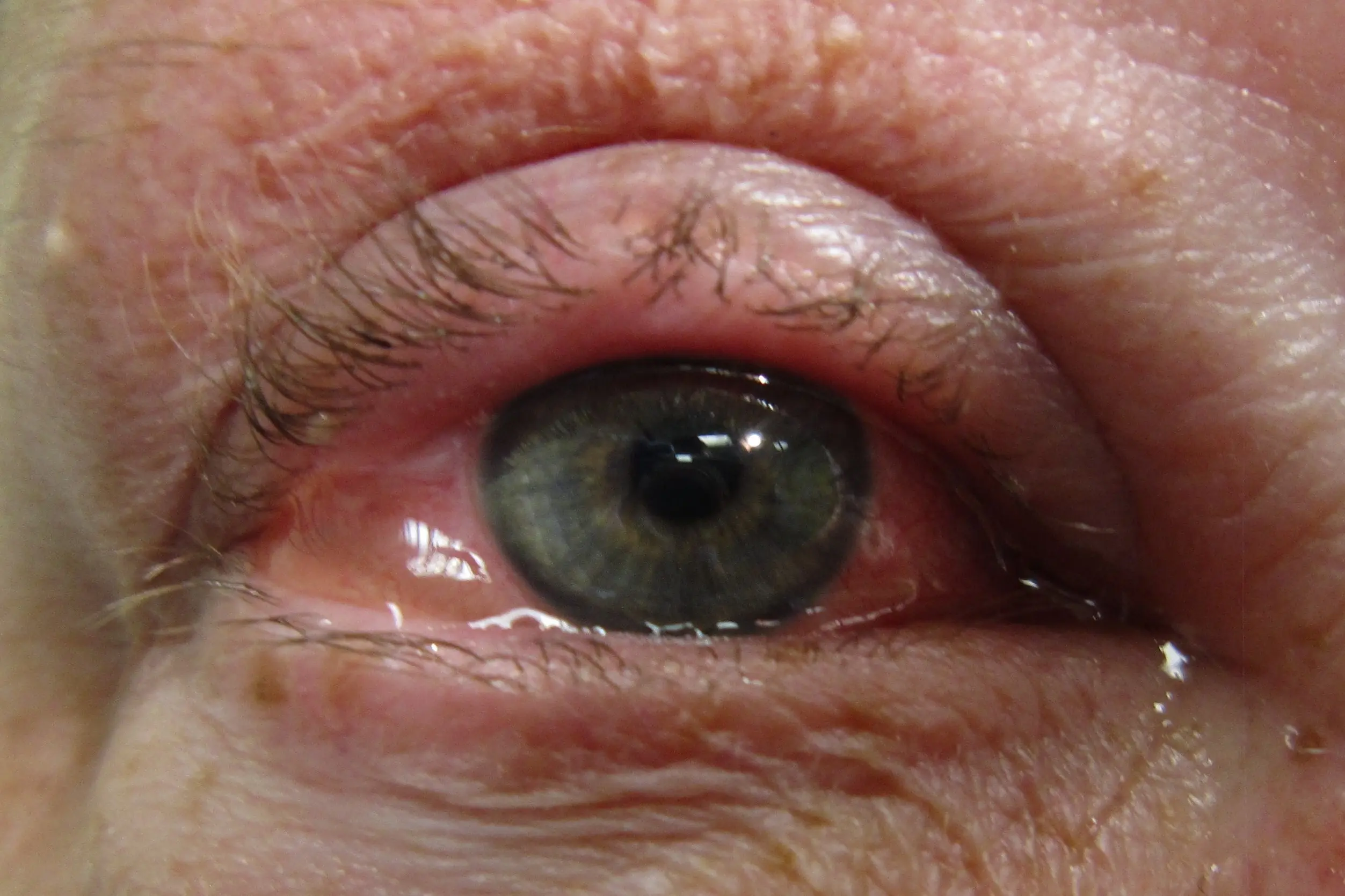 Allergic conjunctivitis in adults