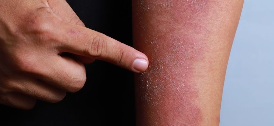 Allergic dermatitis in adults