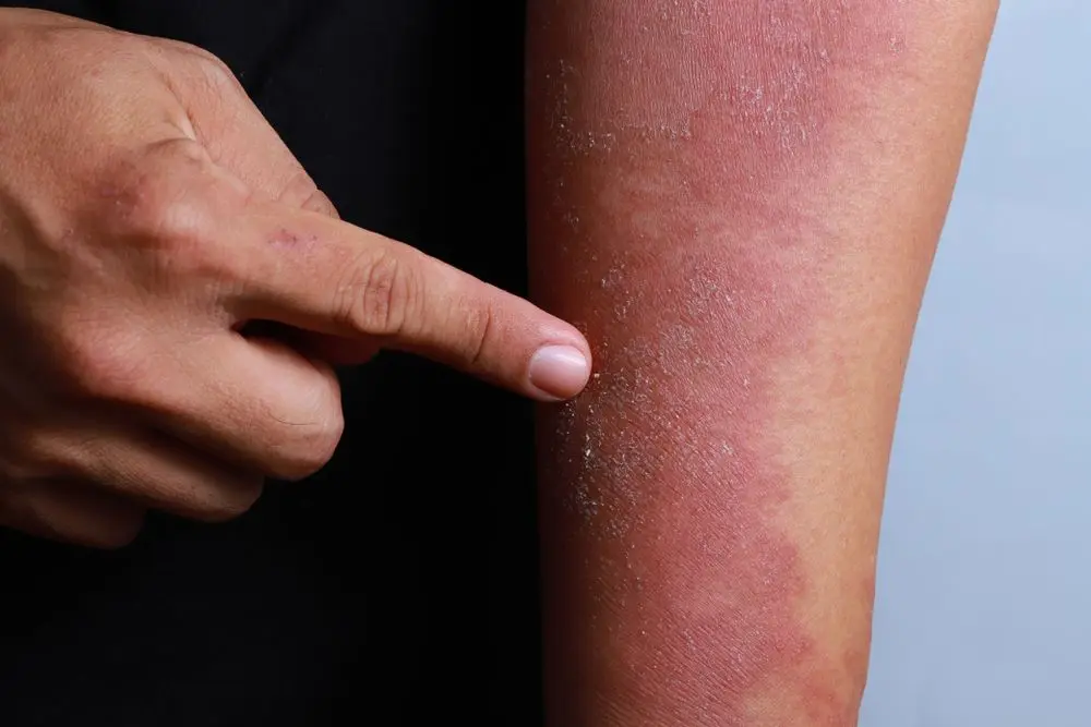 Allergic dermatitis in adults