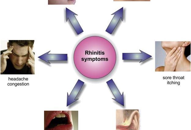 Allergic rhinitis in adults