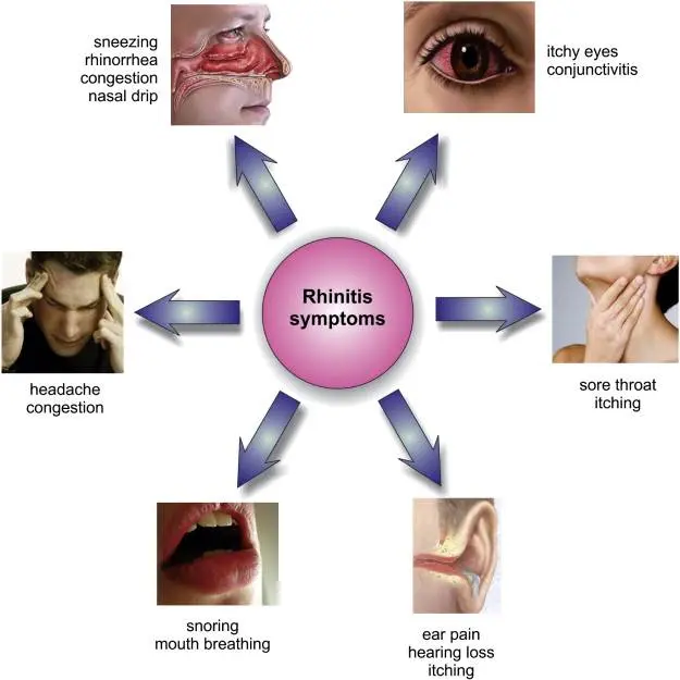 Allergic rhinitis in adults