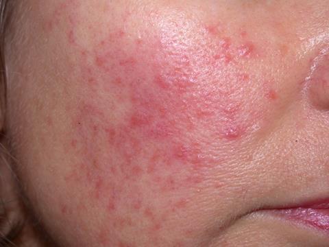 Allergy on the face in adults