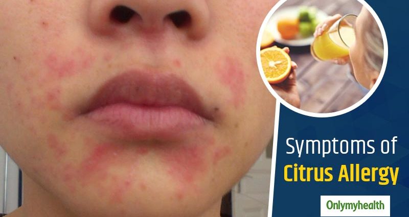 Allergy to citrus fruits in adults