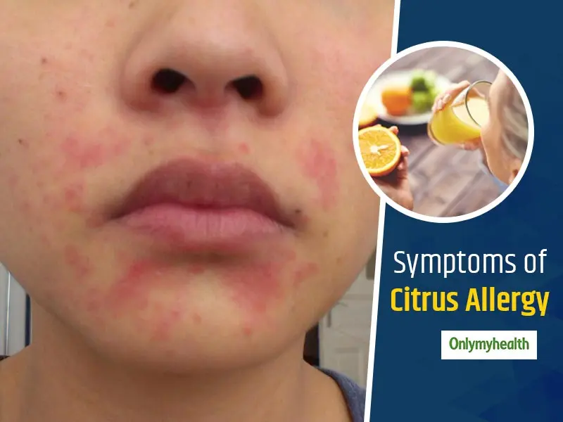 Allergy to citrus fruits in adults