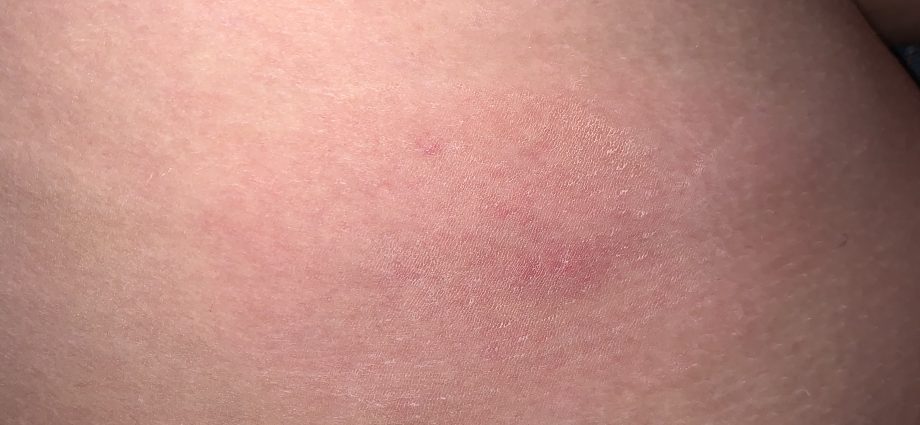 Allergy to mosquito bites in adults