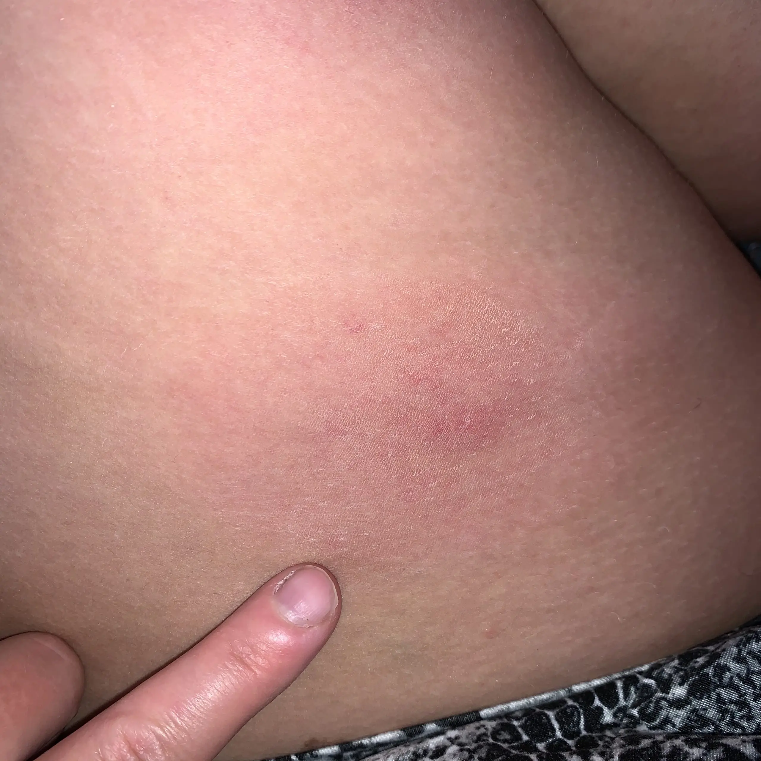 Allergy to mosquito bites in adults