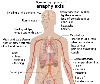 Anaphylactic shock in adults