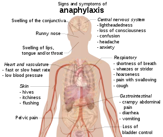 Anaphylactic shock in adults