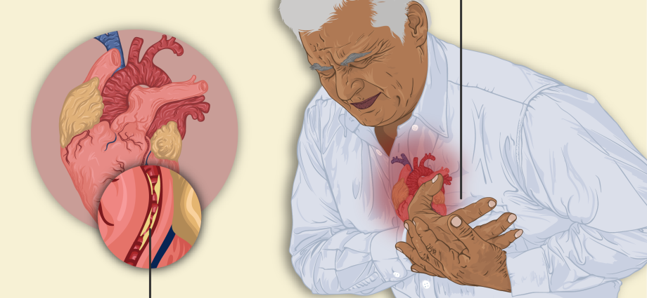 Angina in adults