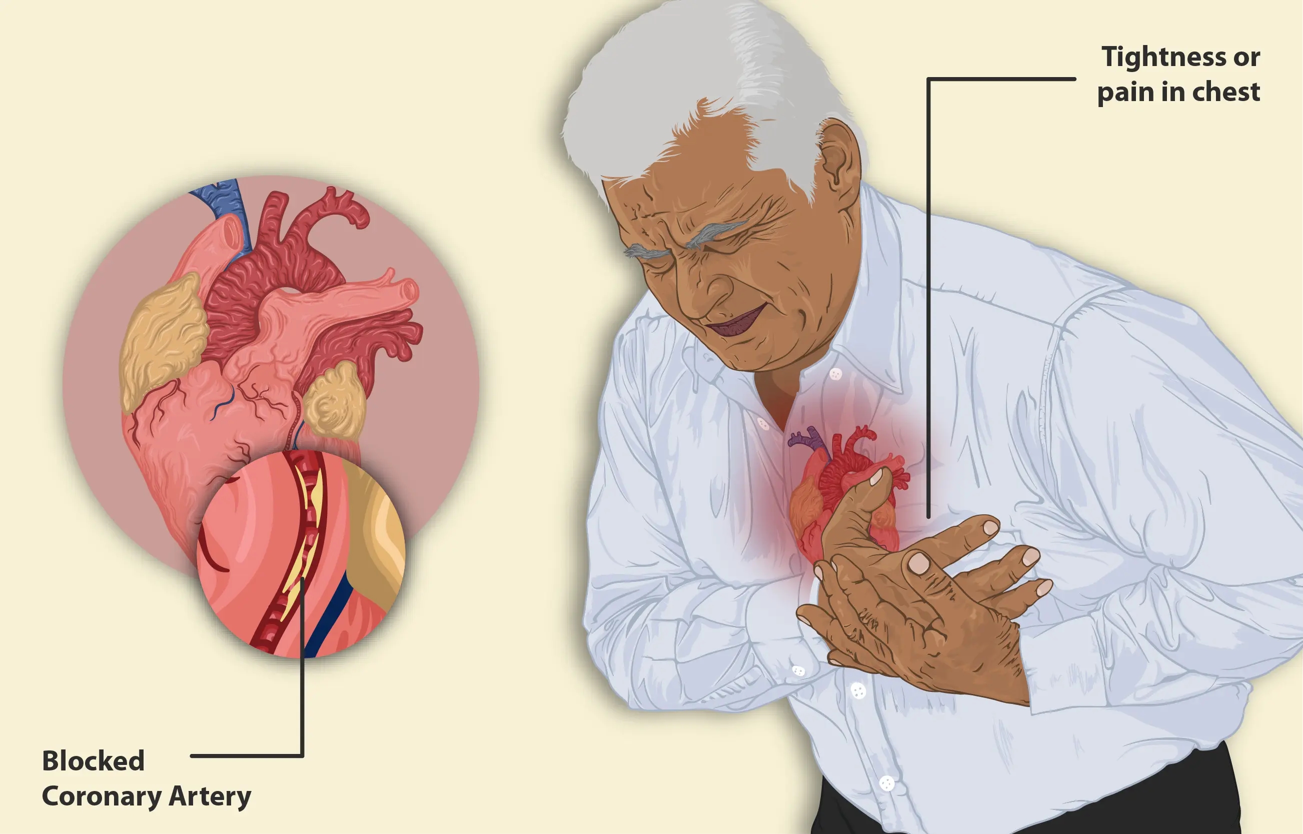 Angina in adults