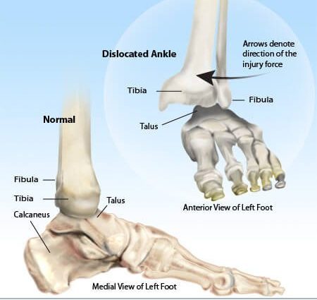 Ankle dislocation