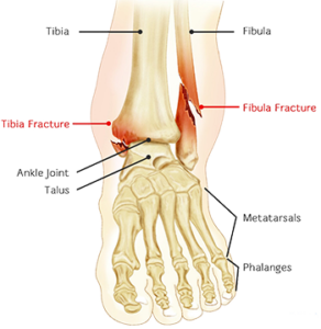 Ankle fracture