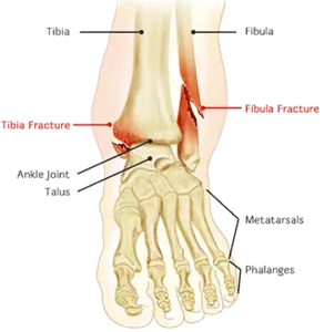 Ankle fracture