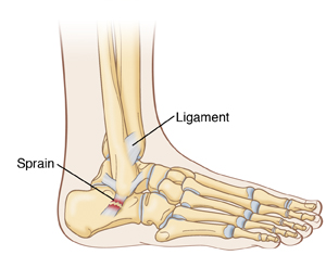 Ankle sprain in adults