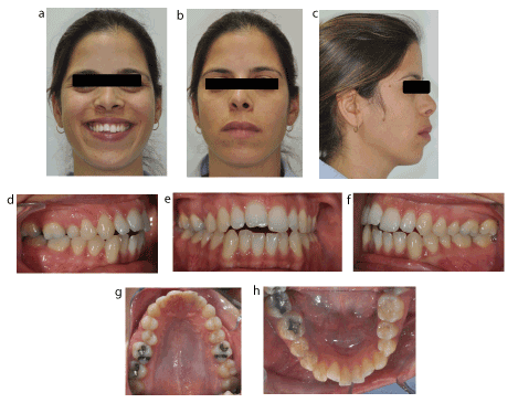 Ankylosis in adults