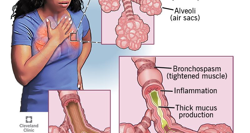 asthma attacks in adults