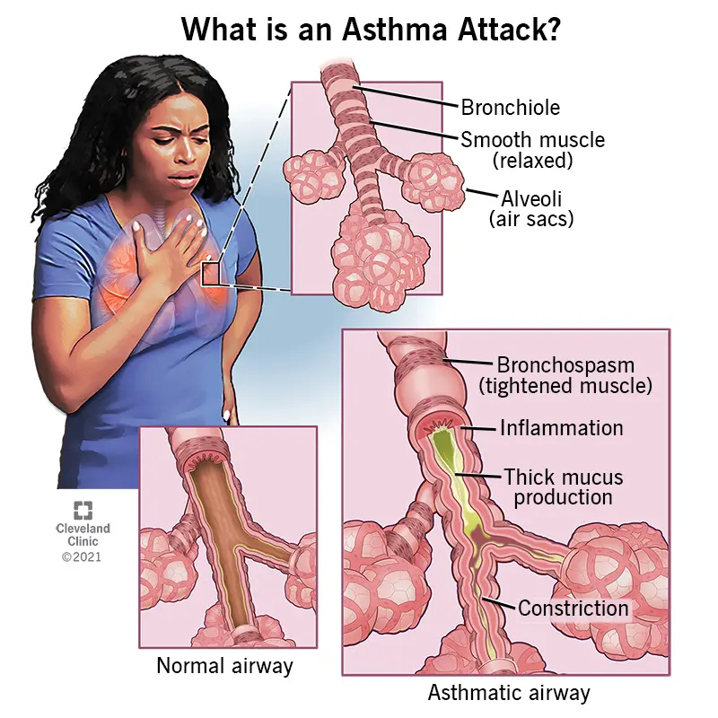 asthma attacks in adults