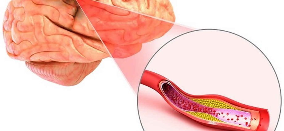 Atherosclerosis of cerebral vessels in adults